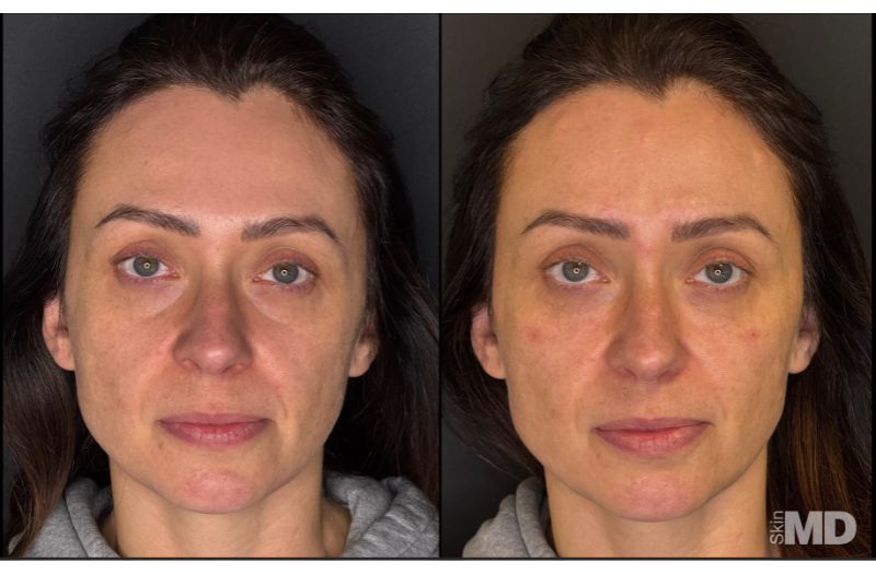 Dermal Filler – Under Eyes #9