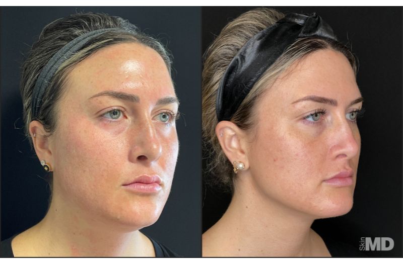 Morpheus8 – Face #2