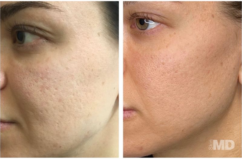 Morpheus8 – Face #3