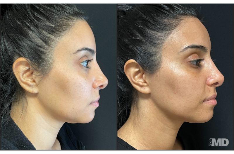 Morpheus8 – Face #5