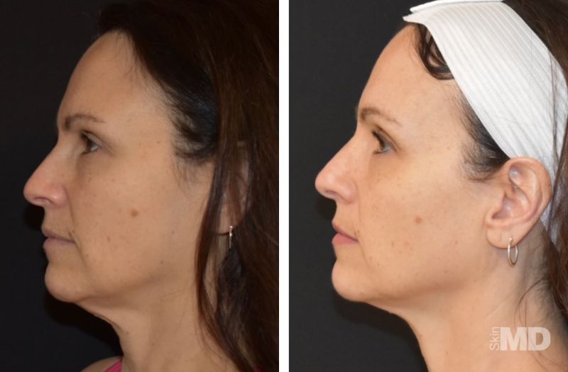 Morpheus8 – Face #6