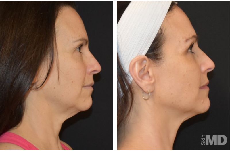 Morpheus8 – Face #7