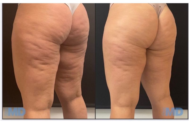 Morpheus8 – Body #1