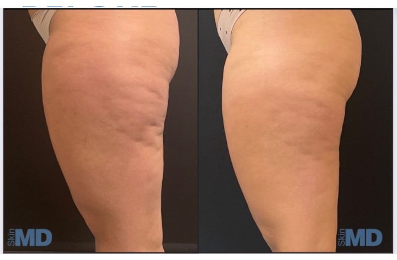 Morpheus8 – Body #3