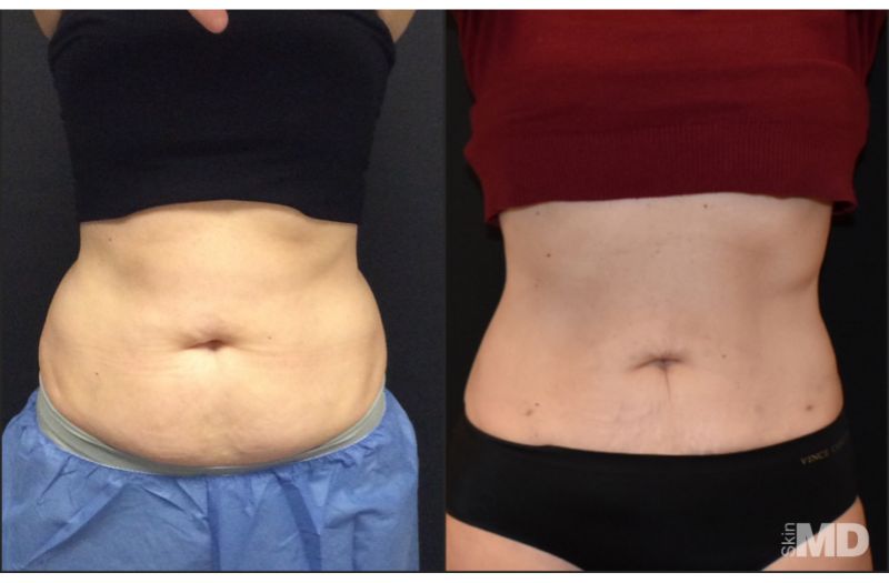 BodyTite Liposuction #1