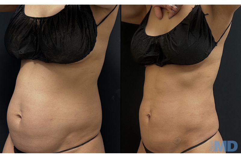 BodyTite Liposuction #2
