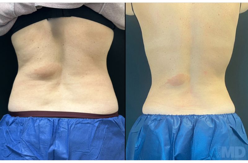 BodyTite Liposuction #3