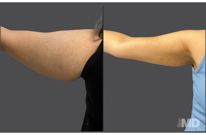 BodyTite Liposuction #4