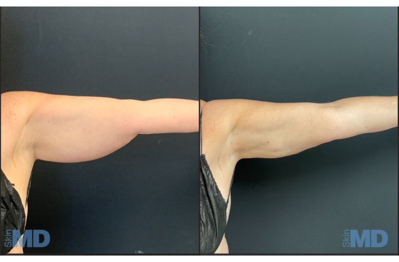 BodyTite Liposuction #5