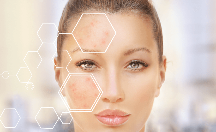 Different Types of Acne Scars and How to Treat Them