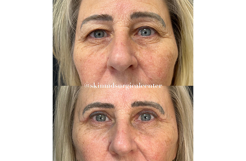 Blepharoplasty #1