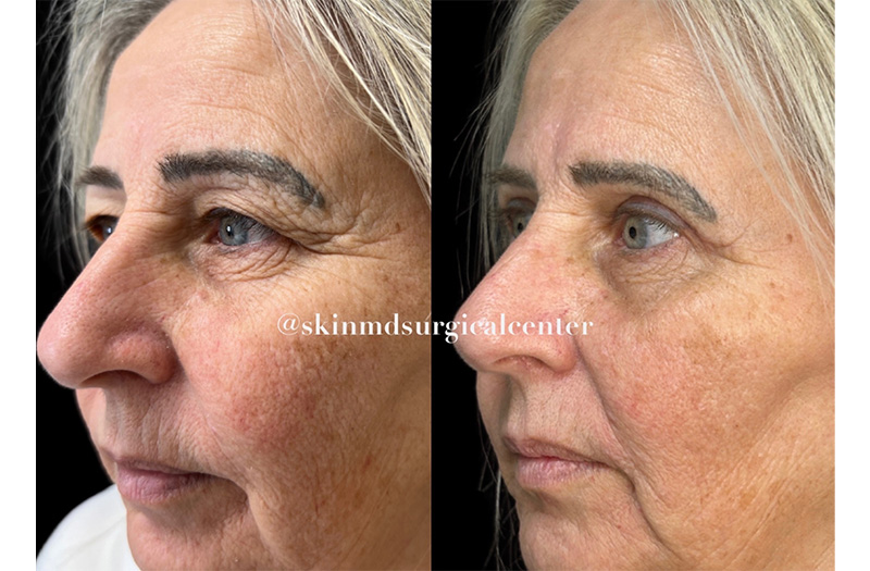 Blepharoplasty #1