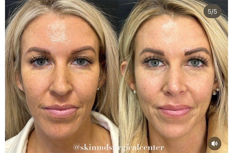 Blepharoplasty #2