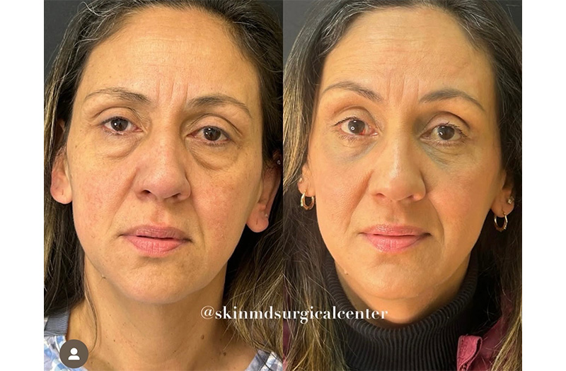 Blepharoplasty #3