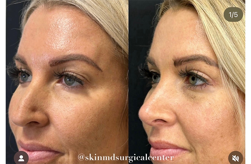 Blepharoplasty #2