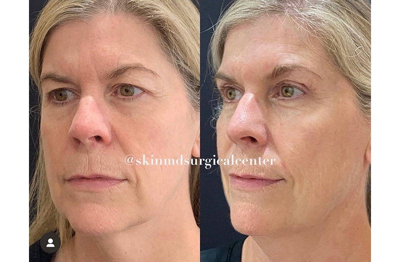 Blepharoplasty #4