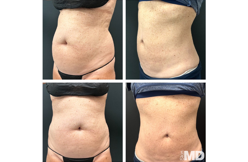 BodyTite Liposuction #10