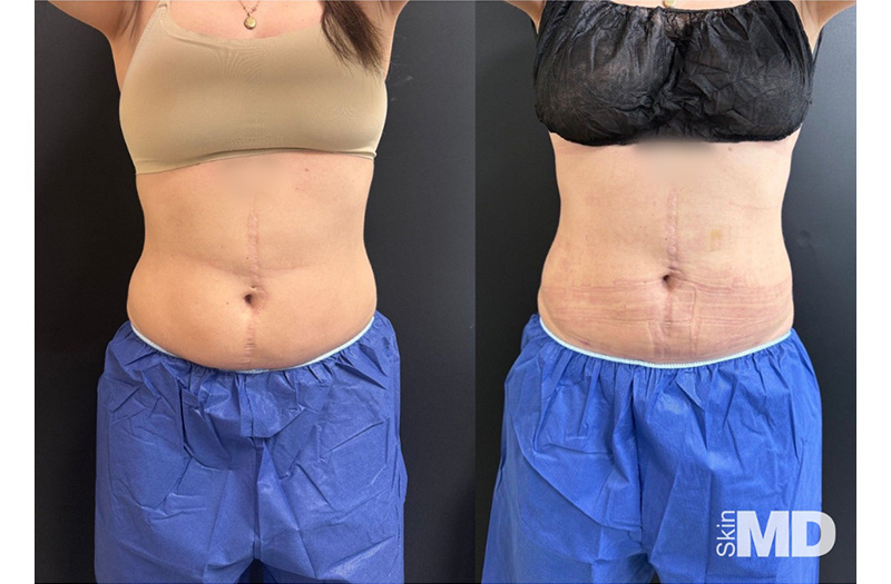 BodyTite Liposuction