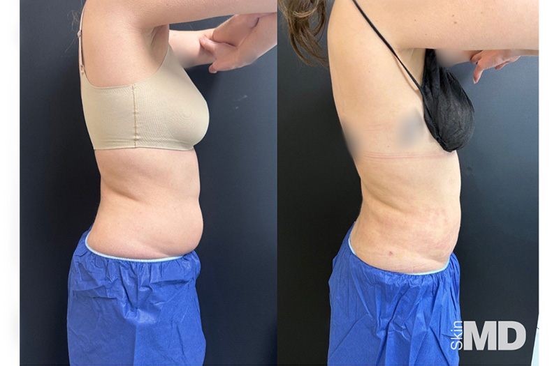 BodyTite Liposuction
