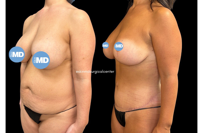 Abdominoplasty #1