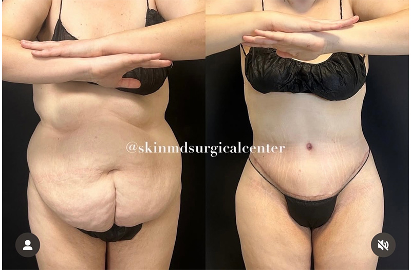 Abdominoplasty #2