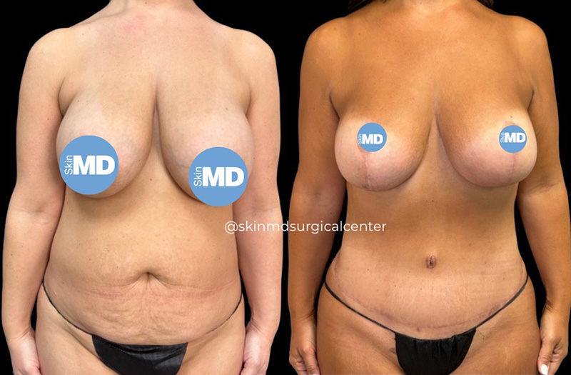 Abdominoplasty #1