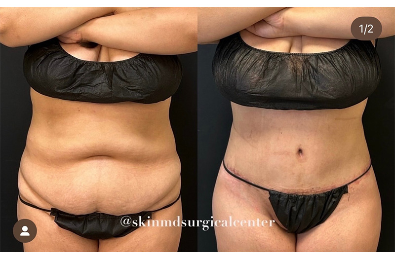 Abdominoplasty #3