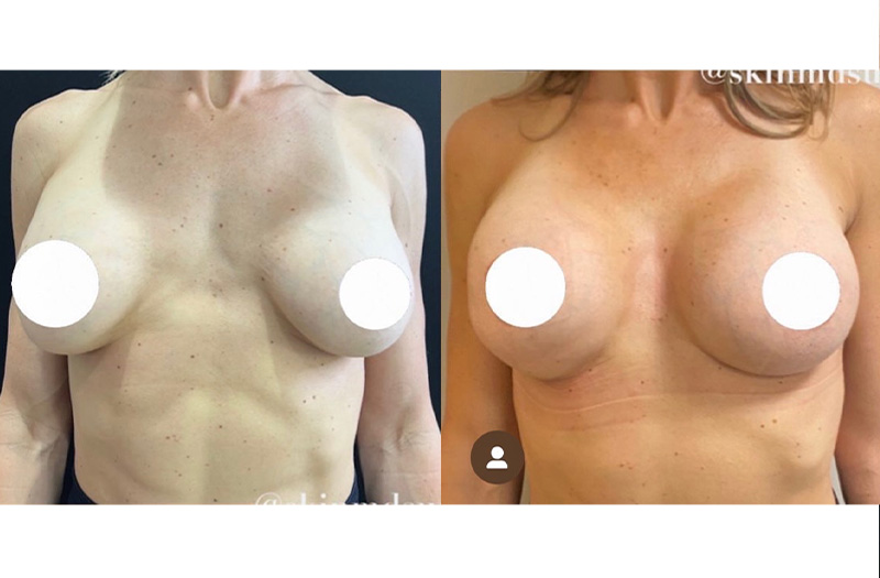 Breast Augmentation  1