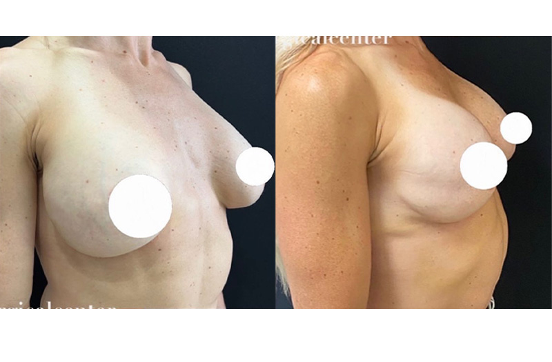 Breast Augmentation 2