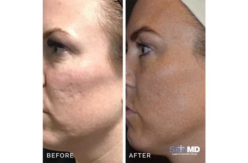 CO2 Laser Resurfacing 5