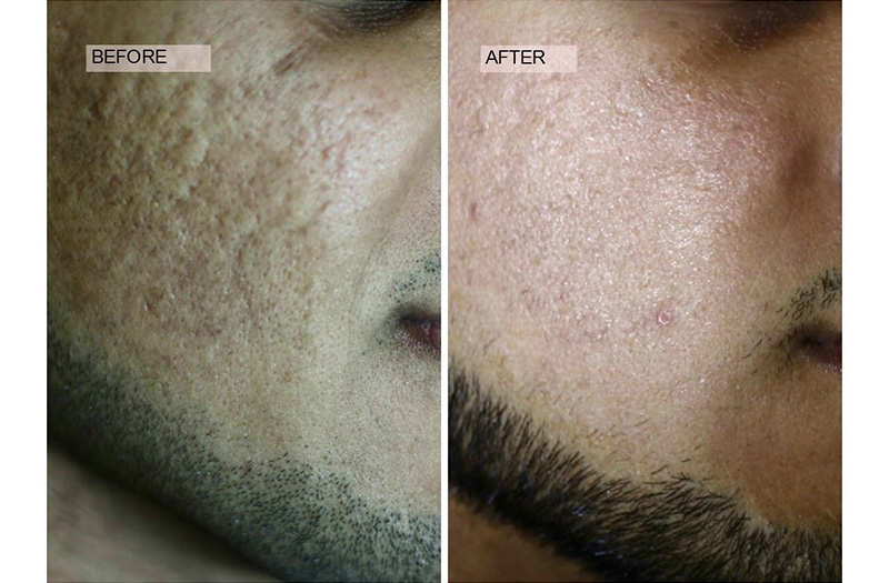 CO2 Laser Resurfacing 4