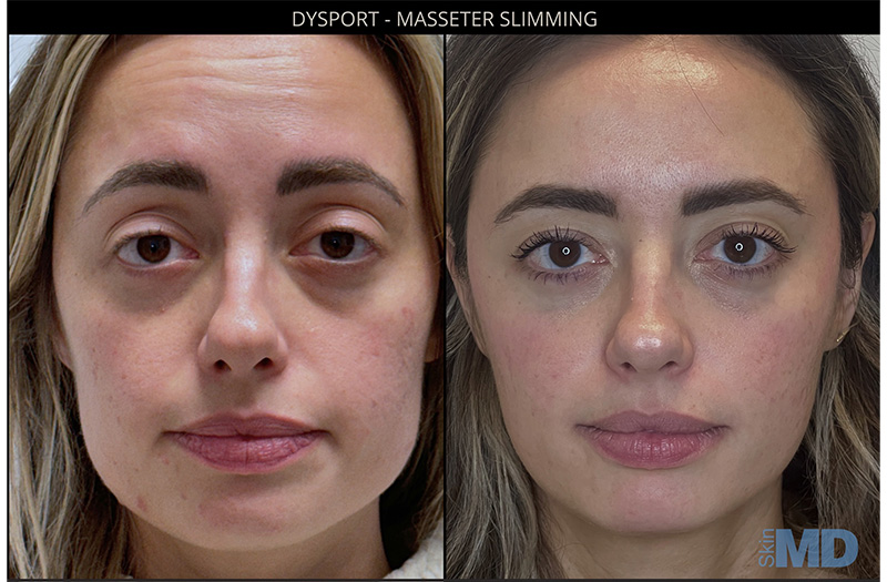 Dysport #4