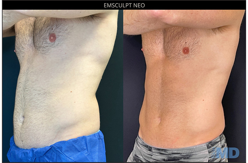 EmSculpt 1