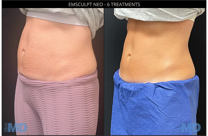 EmSculpt 1