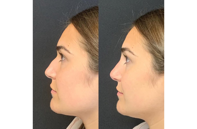 Dermal Filler – Non Surgical Nose #9