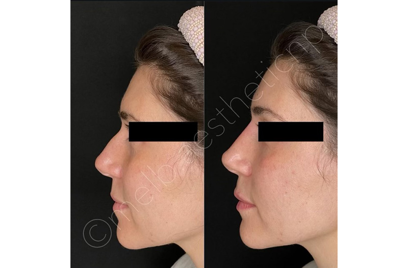 Dermal Filler – Non Surgical Nose #9