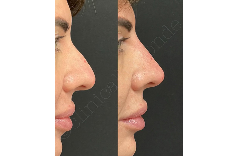 Dermal Filler – Non Surgical Nose #9