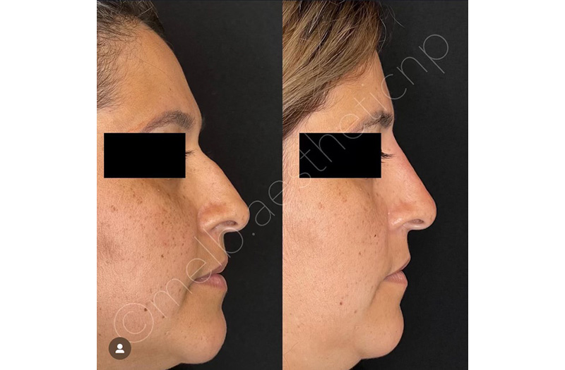 Dermal Filler – Non Surgical Nose #9