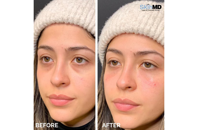 Dermal Filler – Under Eyes #10