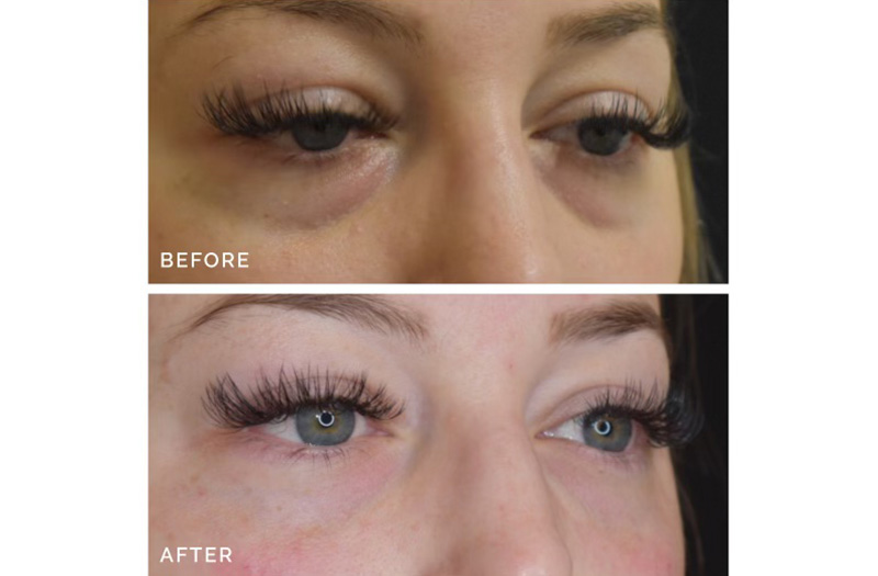 Dermal Filler – Under Eyes #10