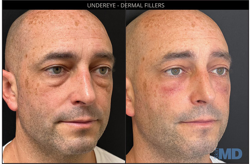 Dermal Filler – Under Eyes #10