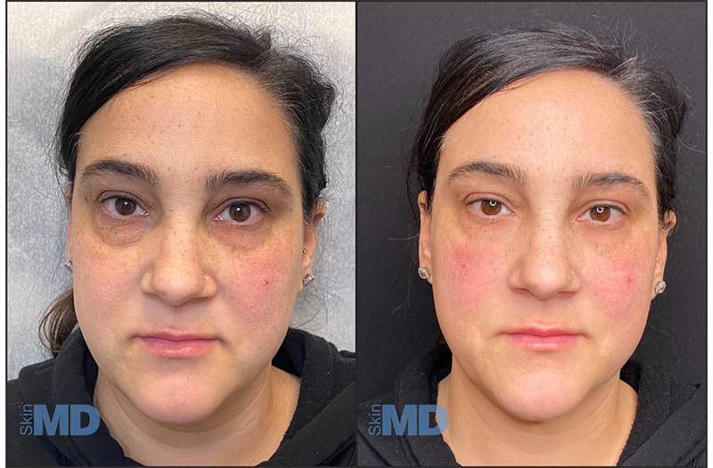 Dermal Filler – Under Eyes #10