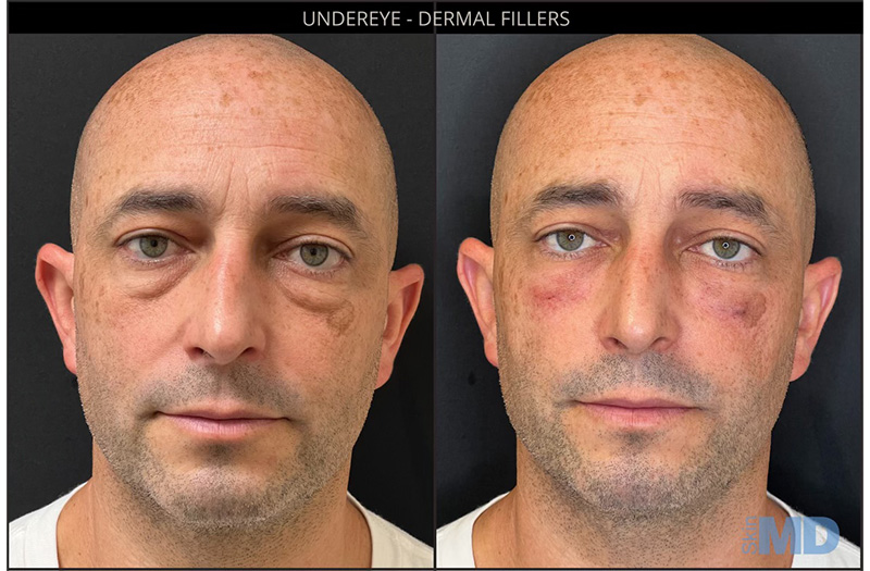Dermal Filler – Under Eyes #10