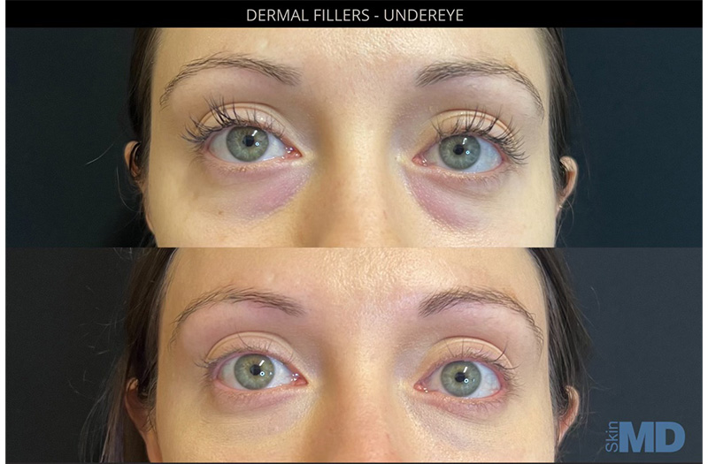 Dermal Filler – Under Eyes #10