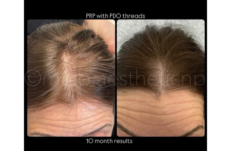 PRP Restoration #1