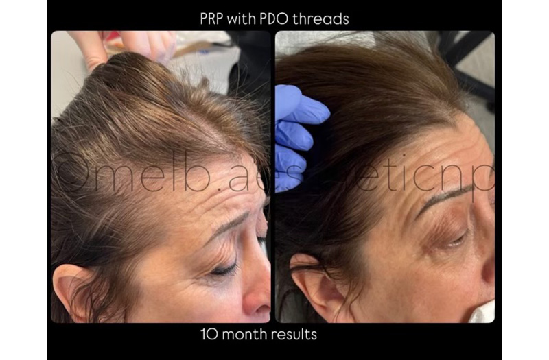 PRP Restoration #1